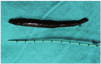 মূত্রথলিতে জোঁক! পুকুরে স্নান করে বিপদে বালক, মধ্যরাতে সফল অস্ত্রোপচার মুর্শিদাবাদ মেডিক্যালে