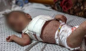 গাজায় শিশুরা মেনিনজাইটিসের কবলে, দ্রুত বাড়ছে সংক্রমণের সংখ্যা