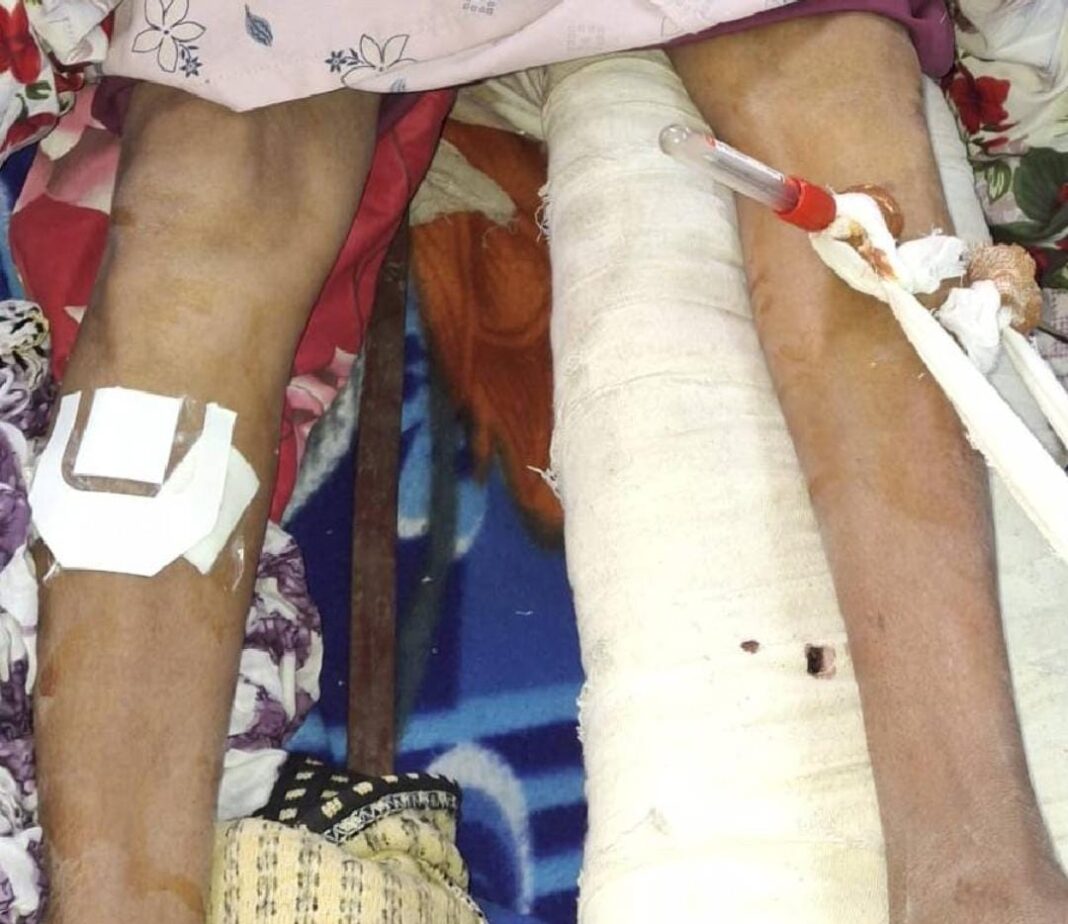 বাঁ পায়ের হাড় ভাঙা, অথচ অস্ত্রোপচার ডান পায়ে! মুর্শিদাবাদ মেডিক্যাল কলেজে চরম গাফিলতির অভিযোগ